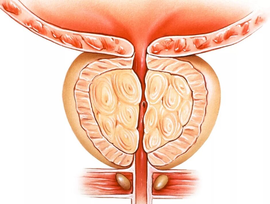 Prostatitas