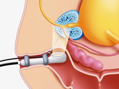 Prostatos liaukos adatos biopsija
