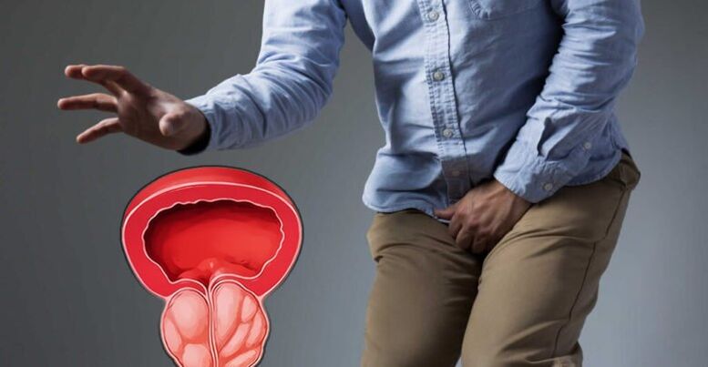 Prostatito ir prostatos adenomos prevencija