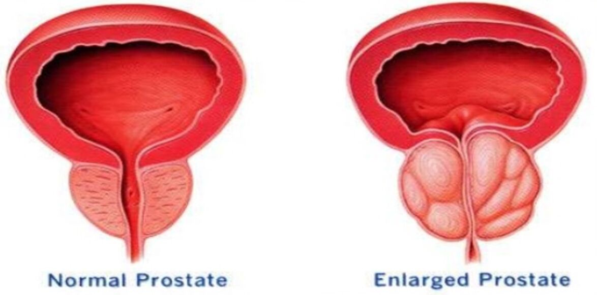 Normali prostata, uždegta prostata
